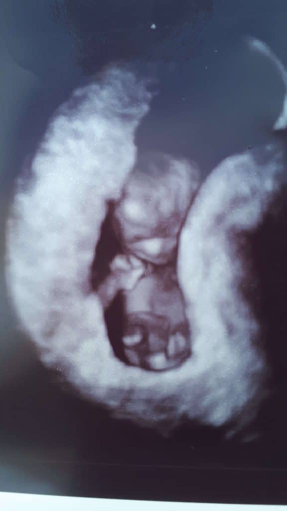 icsi pregnancy ultrasound