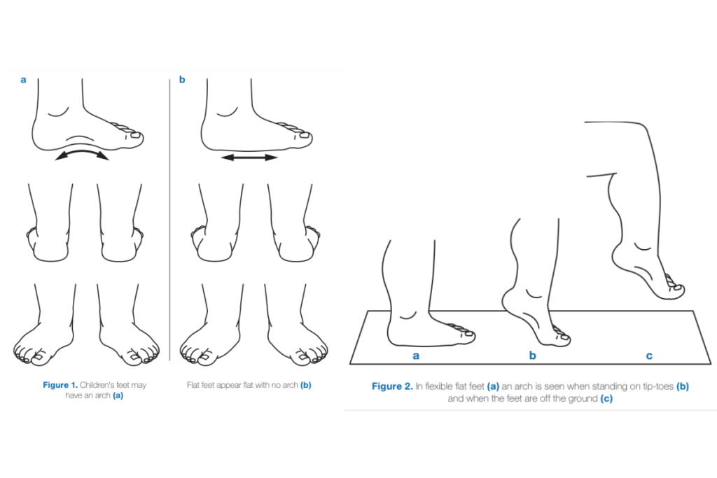 is flat feet normal in babies