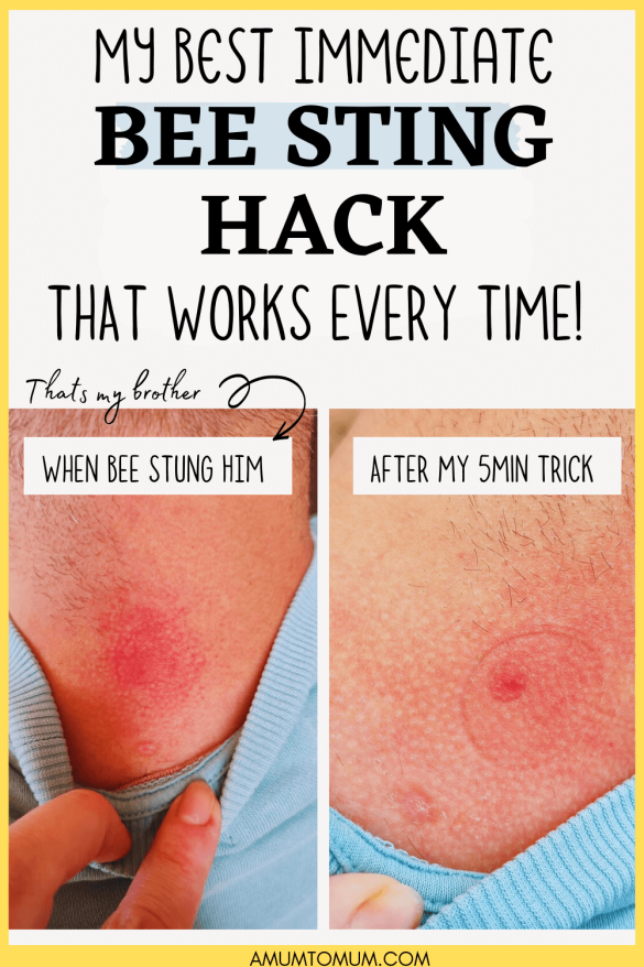 Home Treatment for Bee Sting Works Like Magic!